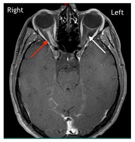 Ophthalmologist Boston | Optic Neuritis Boston | NEEC