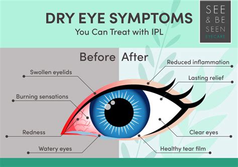 IPL Treatment for Dry Eye: How It Works | Toronto