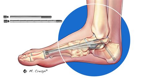 Charcot Foot Reconstruction Using Internal Fixation - Orthofix