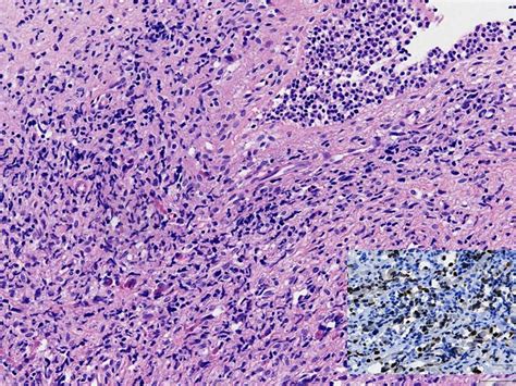 Sarcoma botryoides in an infant | BMJ Case Reports