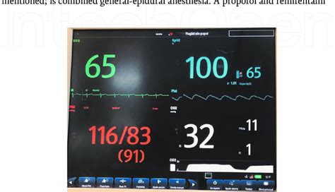 Standard ASA monitoring (American Society of Anestesiologists ...