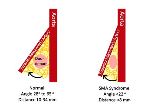 Superior Mesenteric Artery Syndrome (SMA Syndrome) in Children — Pediatric EM Morsels