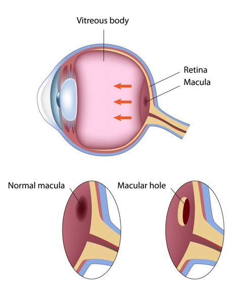 What is a macular hole?