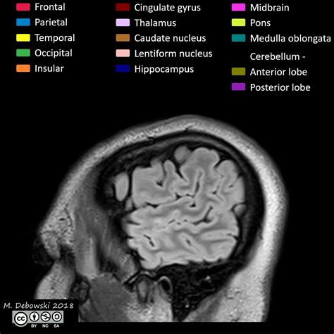 Brain lobes - annotated MRI (Radiopaedia 61691-69700 Sagittal) - NC Commons