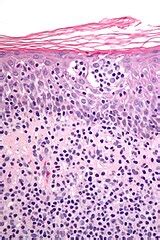 Cutaneous T-cell lymphoma - Libre Pathology