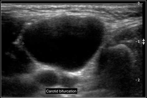 Cervical Lipoma Ultrasound | Ownerlip.co