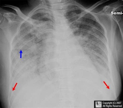 (DOCX) Edema Paru - DOKUMEN.TIPS