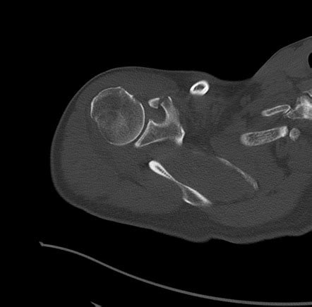 Coracoid process fracture | Radiology Case | Radiopaedia.org