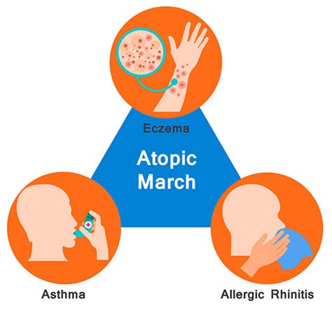 What is Atopic March and How to Treat It?