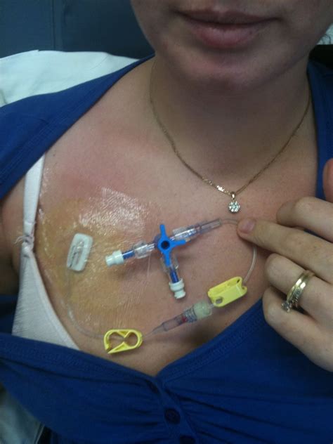 Vanquishing Triple Negative Breast Cancer My Way: Chemo Session One ...