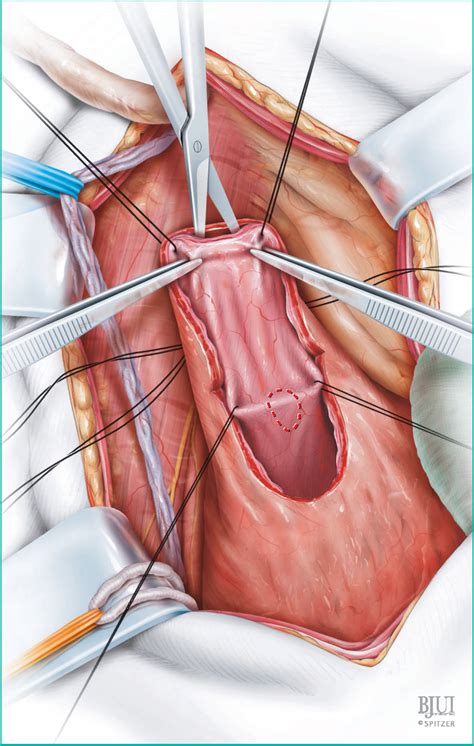 Figure 8 from Psoas hitch and Boari flap ureteroneocystostomy. | Semantic Scholar