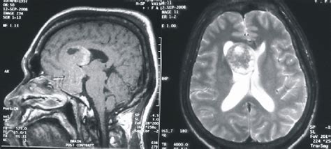 Macroadenoma of pituitary gland with diameter 2.3x3.5x6.6 cm3 that ...