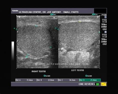 Ultrasound imaging: Orchitis- left testis