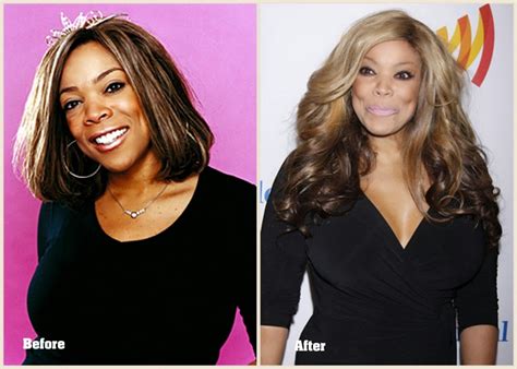 Wendy Williams Plastic Surgery