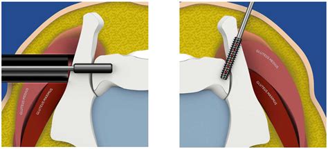 A Helpful Guide to Sacroiliac Joint Fusion for Pain and Dysfunction ...