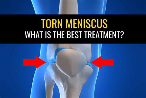 Meniscus Tear Treatment | Torn Meniscus Exercises