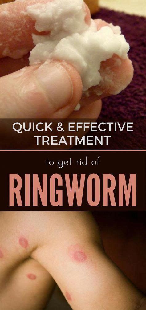Fungus Infection Nail #ToeFungusTreatmentBest #LasikSurgery | Home remedies for ringworm ...