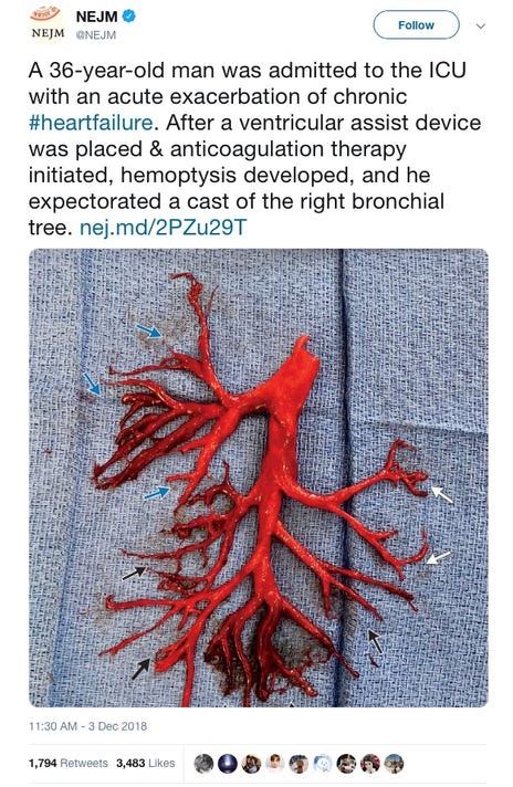 NEJM shares odd photo of blood clot shaped like lung. A man spit it up