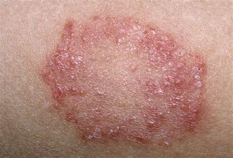 Common Childhood Skin Disorders | Skin rashes pictures, Fungal nail ...