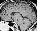 Category:MRI of hypothalamic hamartoma - Wikimedia Commons