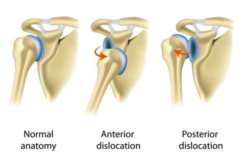 Dislocated Shoulder | Instability | Orthopedic Shoulder Specialist ...