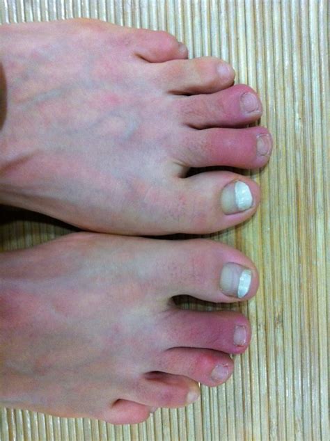 Chilblains and Its Causes, Symptoms, Measures and Treatment - Earth's ...