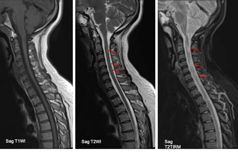 Multiple sclerosis – Radiology Cases