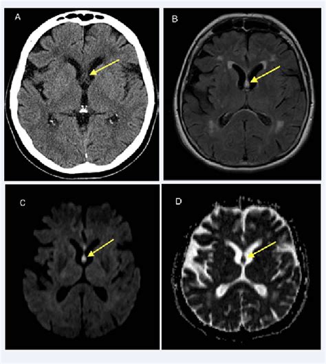 Fornix Mri