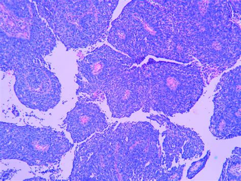 BASALOID SQUAMOUS CELL CARCINOMA – Histopathology.guru