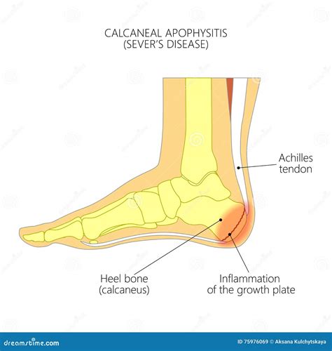 Calcaneal Apophysitis stock vector. Illustration of inflammation - 75976069