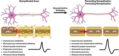 Neurodegeneration in multiple sclerosis - Mey - 2023 - WIREs Mechanisms of Disease - Wiley ...