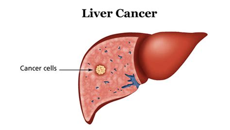 Liver Cancer Homeopathy Treatment In Mumbai, Delhi & Lucknow - Expert ...