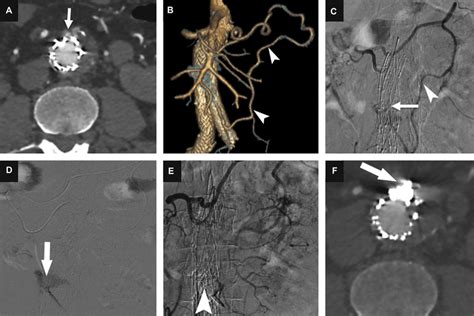 Transarterial embolization of type II endoleak via the inferior ...