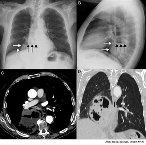 Extensive Cavitary Lung Cancer Mimicking Paraesophageal Hiatal Hernia ...