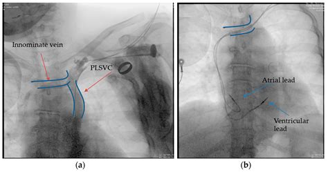 Svc And Innominate Vein Anatomy