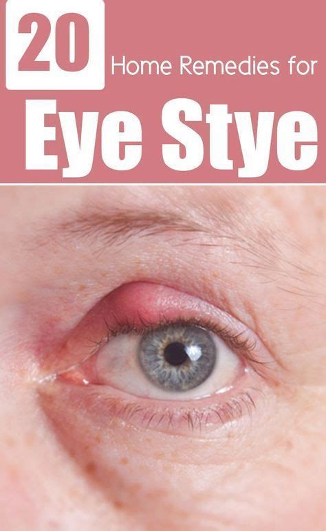 26 Effective Home Remedies To Get Rid Of Eye Stye | Natural home ...