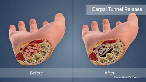 Carpal Tunnel Release – UnderstandOrtho™