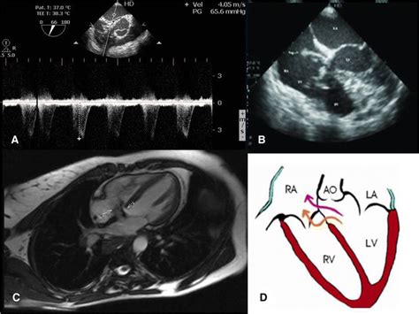 Transesophageal echocardiography demonstrating the shunt between the... | Download Scientific ...