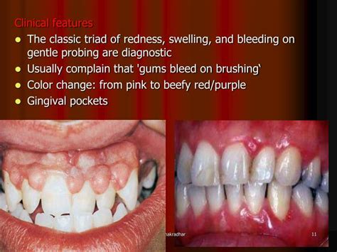 PPT - Gingivitis Inflammation of gingival tissues commonly associated with dental plaque ...