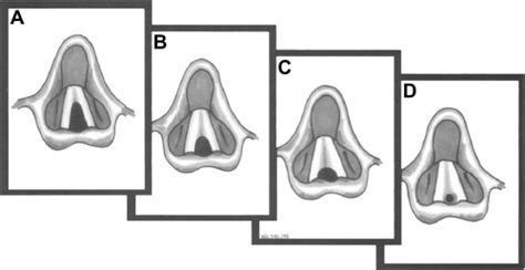 The Anterior Laryngeal Webs | Ento Key