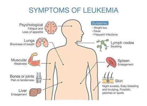 Leukemia Symptoms; 11 Common Leukemia Signs & Symptoms