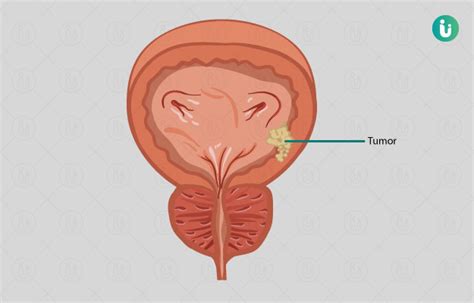 ब्लैडर (मूत्राशय) कैंसर के लक्षण, कारण, इलाज, दवा, उपचार - Bladder ...