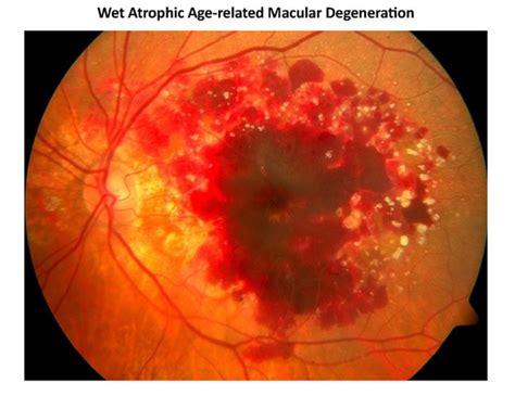 Stages of AMD - AMD | Patient & Caregiver