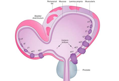 Bladder Diverticulum - Signs and Symptoms, Treatment in India