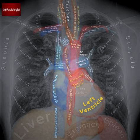 Labeled Chest X-Ray Anatomy by Dr. Naveen Sharma - ... Radiology Student, Radiology Imaging ...