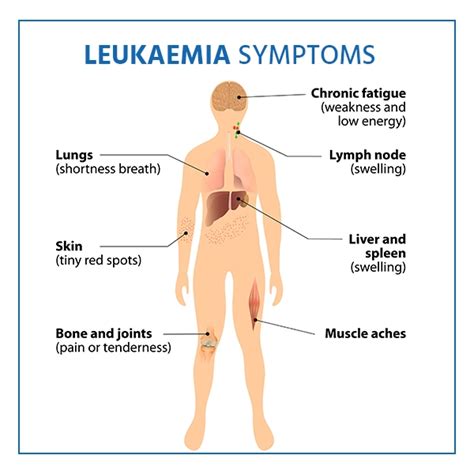 Understanding Leukemia: Causes, Symptoms, And Treatment - Ask The Nurse ...