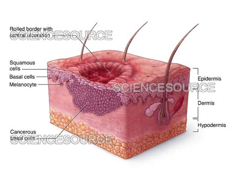 Basal Cell Carcinoma Illustration | Stock Image - Science Source Images