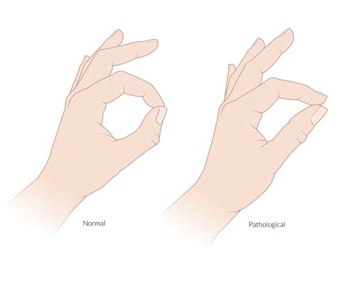 Median Nerve Palsy