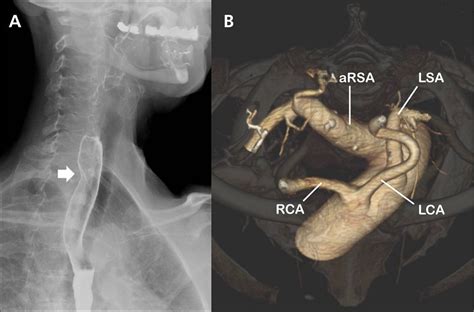 Left and Right Subclavian Artery Function, Branches, Stenosis