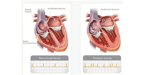 La arritmia cardiaca más frecuente en México, Fibrilación Auricular (FA ...